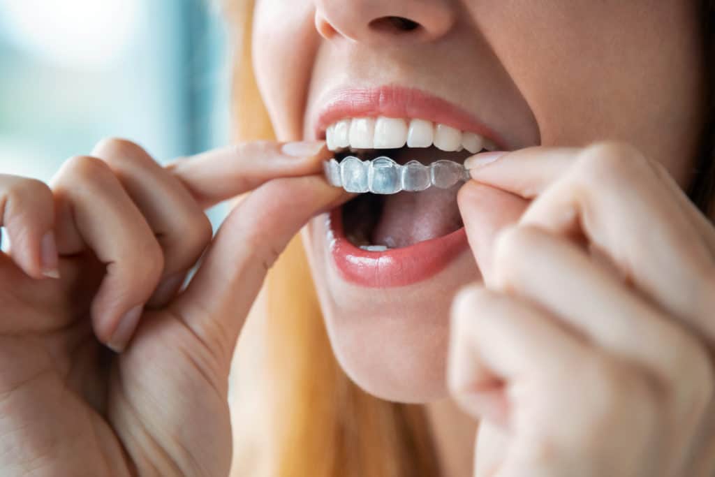 Close up of woman putting on clear invisalign aligners