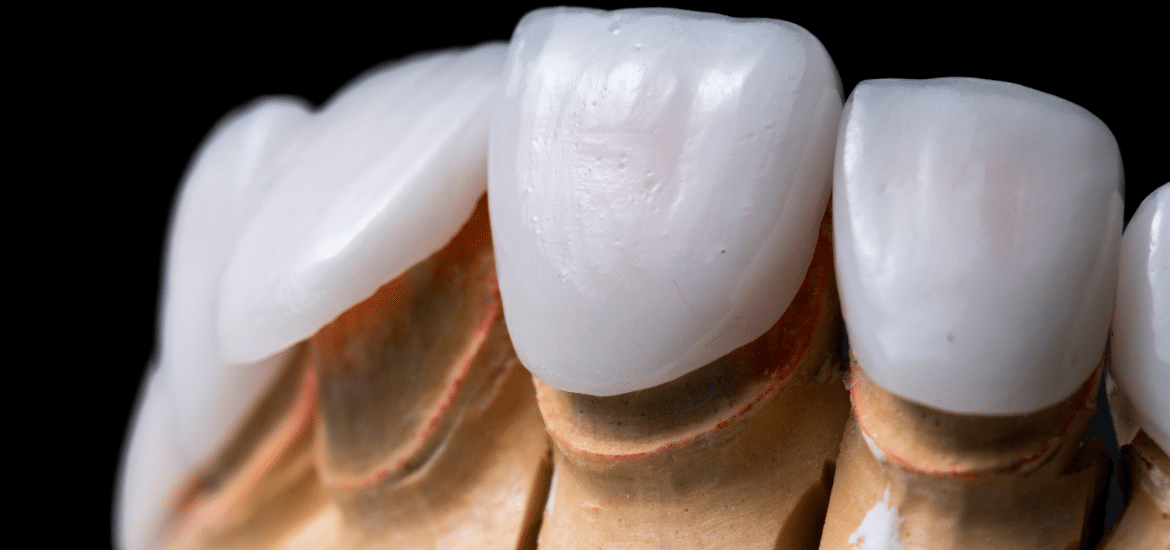 press ceramic veneers at Pacific Northwest Smiles at Mill Creek