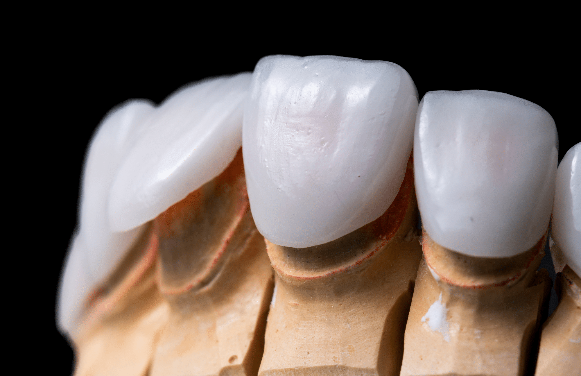 press ceramic veneers at Pacific Northwest Smiles at Mill Creek