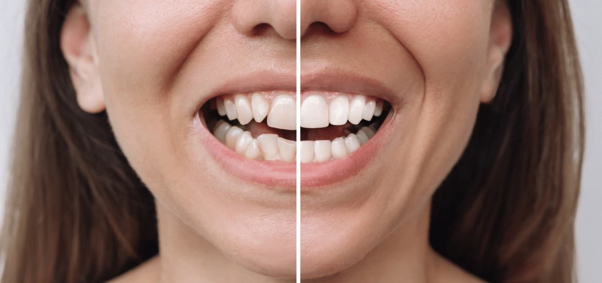 young caucasian smiling confidently caucasian woman before and after veneer installation at Pacific Northwest Smiles at Mill Creek