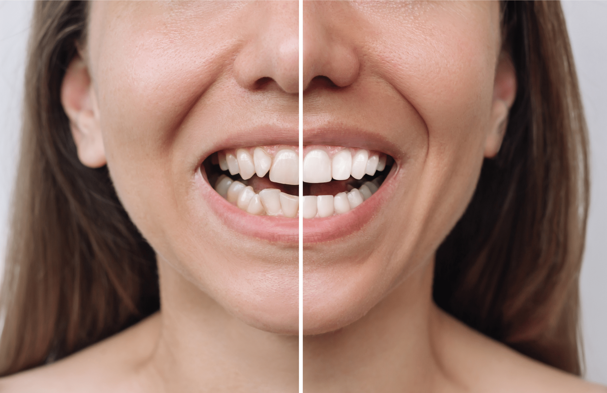 young caucasian smiling confidently caucasian woman before and after veneer installation at Pacific Northwest Smiles at Mill Creek